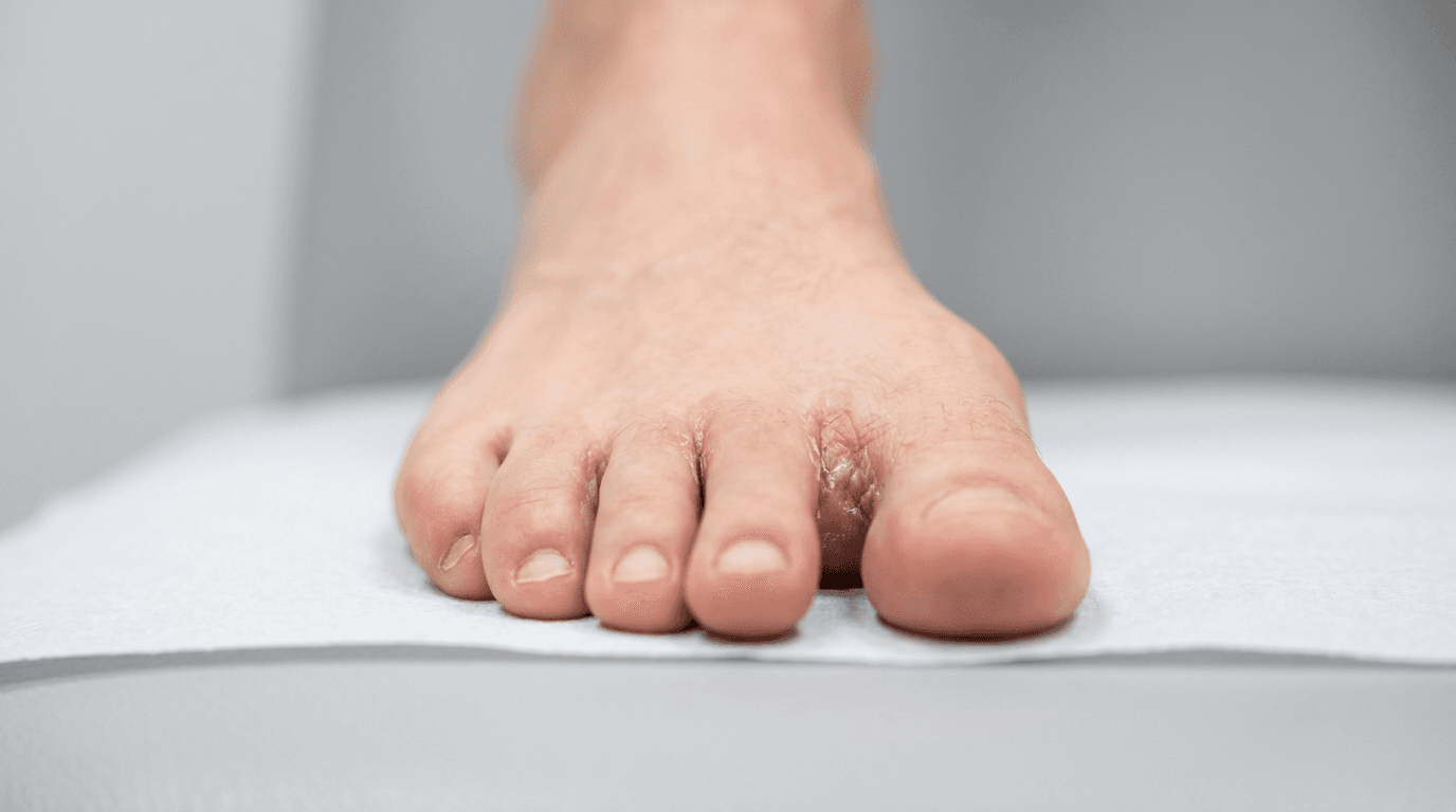 Pied d'athlete