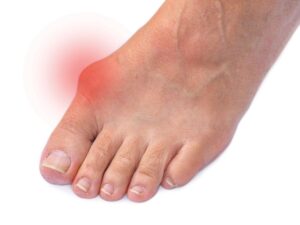 Un oignon déforme l'hallux (orteil gros) de ce pied, causant de la douleur et de l'inconfort.
