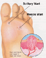 Verrue : causes et traitements, Clinique Skin Marceau